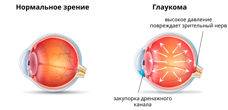 Глаукома